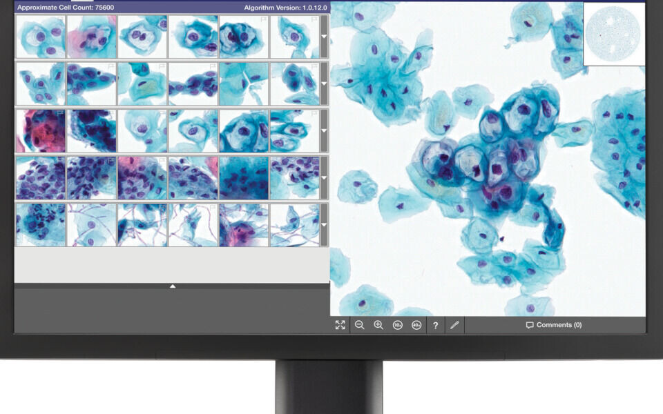 GeniusTM digital cytologi diagnostisk system for livmorhalsprøver. Bildet viser utvalgte klinisk relevante celler og mikrober plassert i et galleri med 30 bilder, for vurdering av bioingeniør/patolog. Navn på skjerm er operatørnavn. Skjermene har 4K-oppløsning og fargekalibreres automatisk ved behov. Bildet er utlånt av Hologic.