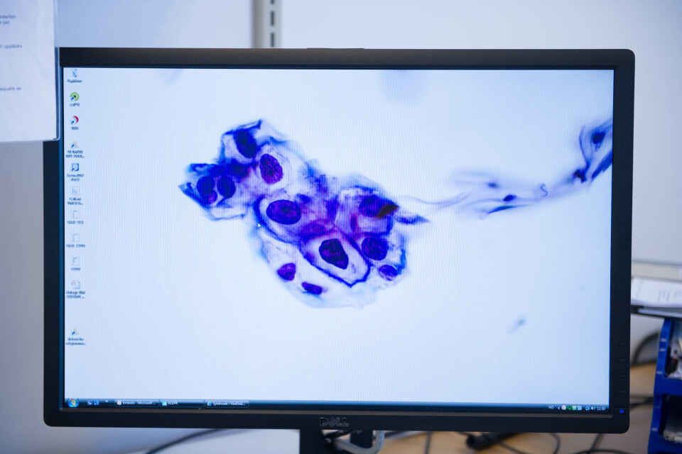 Bioingeniørene finner «noe» i rundt ti prosent av prøvene de analyserer. Her er cellekjernene større og kraftigere farget enn normalt, og noen av kjernene har mistet sin runde form. Prøven viser lavgradige celleforandringer (LSIL), og sendes videre til mikrobiologisk avdeling for HPV-test. Vedvarende infeksjon med humant papillomavirus (HPV) av høyrisikotype kan føre til livmorhalskreft. Lavgradige celleforandringer (LSIL)
