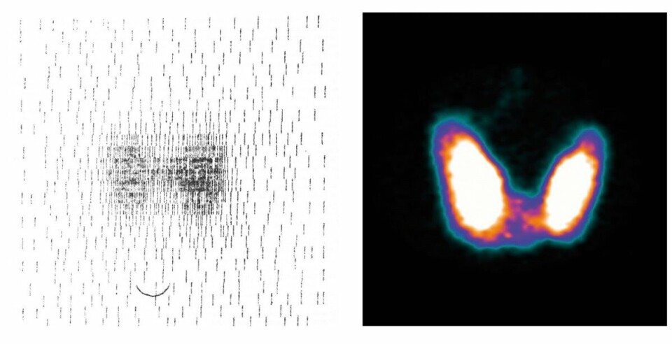 Figur 1: Thyroideaundersøkele i 1966 og 2016. Til venstre illustrasjon fra Rootwelts artikkel (2), til høyre en SPECT/CT-undersøkelse med pinnhullkolliminator (AHUS). Thyroideaundersøkele i 1966 og 2016.