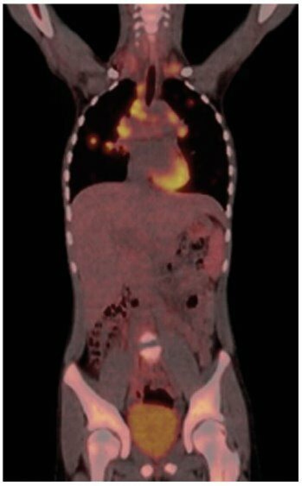 Figur 3: Eksempel på en PET/CT undersøkelse hvor man får kombinert avbildning av fysiologi og anatomi. Stoffet FDG, som er den mest brukte traceren til PET/CT undersøkelse, tas opp i høyere grad i kreftsvulster enn normalt vev. Figur 3: Eksempel på en PET/CT undersøkelse hvor man får kombinert avbildning av fysiologi og anatomi. Stoffet FDG, som er den mest brukte traceren til PET/CT undersøkelse, tas opp i høyere grad i kreftsvulster enn normalt vev.