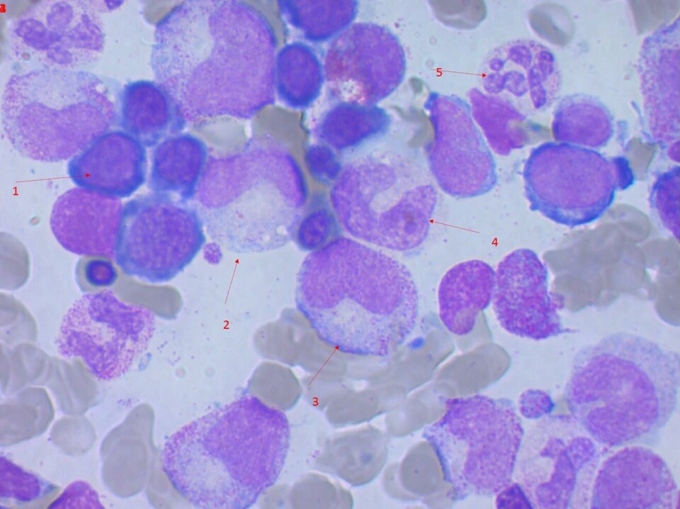 Bilde 1: Benmargsutstryk fra pasient med klassisk B12-mangel. 1 er en erytroblast, 2 og 3 store metamyelocytter, 4 er en kjempestav og 5 er en hypersegmentert nøytrofil granulocytt. Foto: Inger Berit Hersleth. Benmargsutstryk fra pasient med klassisk B12-mangel. 1 er en erytroblast, 2 og 3 store metamyelocytter, 4 er en kjempestav og 5 er en hypersegmentert nøytrofil granulocytt. Foto: Inger Berit Hersleth.