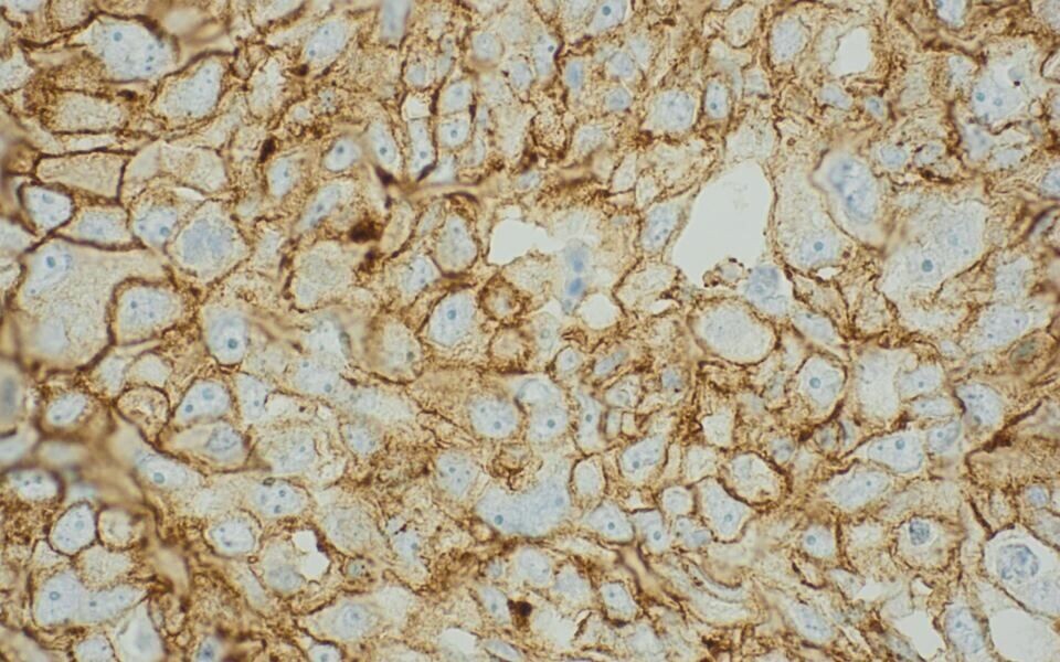 Kreftceller fra pasient som er aktuell for pembrolizumab-behandling. Den brune ringen rundt cellene viser at PD-L1 er til stede. Foto: Universitetssykehuset Nord-Norge