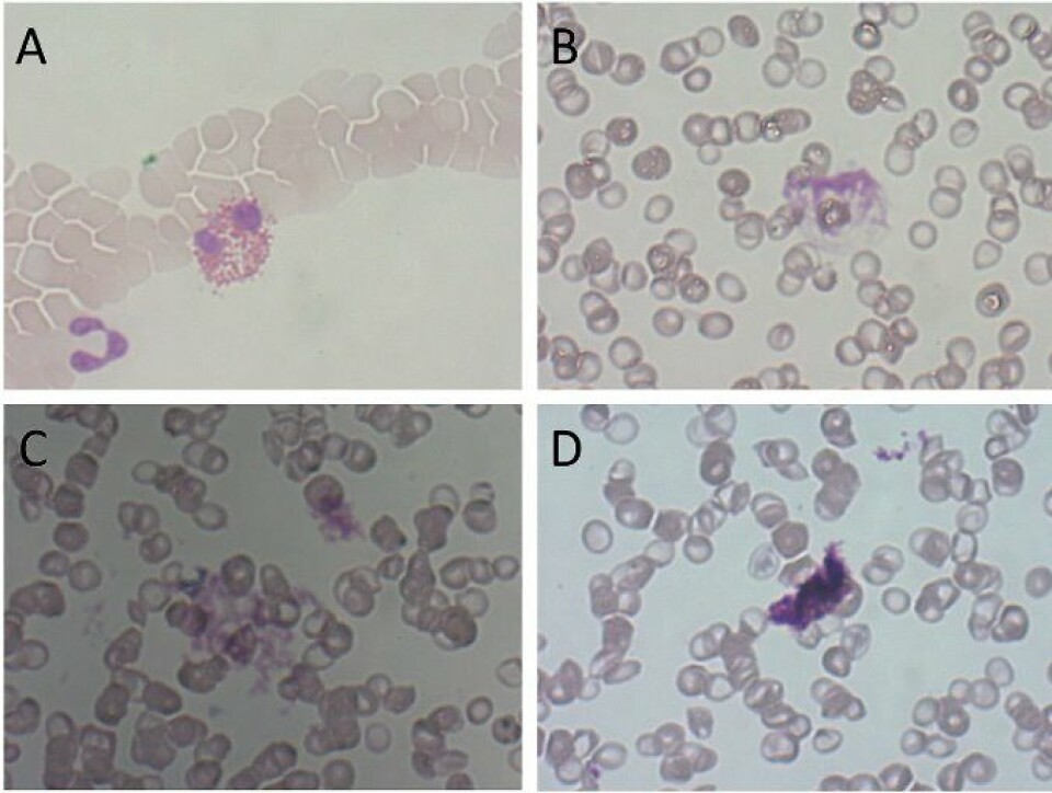 Figur 2: Eksempler på artefakter som kan oppfattes som trombocyttaggregater i blodutstryk; ødelagt eosinofil granulocytt (A), kjerneskygge (B) og fargeutfellinger (C og D). Alle foto: Heidi Andersen Figur 2: Eksempler på artefakter som kan oppfattes som trombocyttaggregater i blodutstryk; ødelagt eosinofil granulocytt (A), kjerneskygge (B) og fargeutfellinger (C og D).