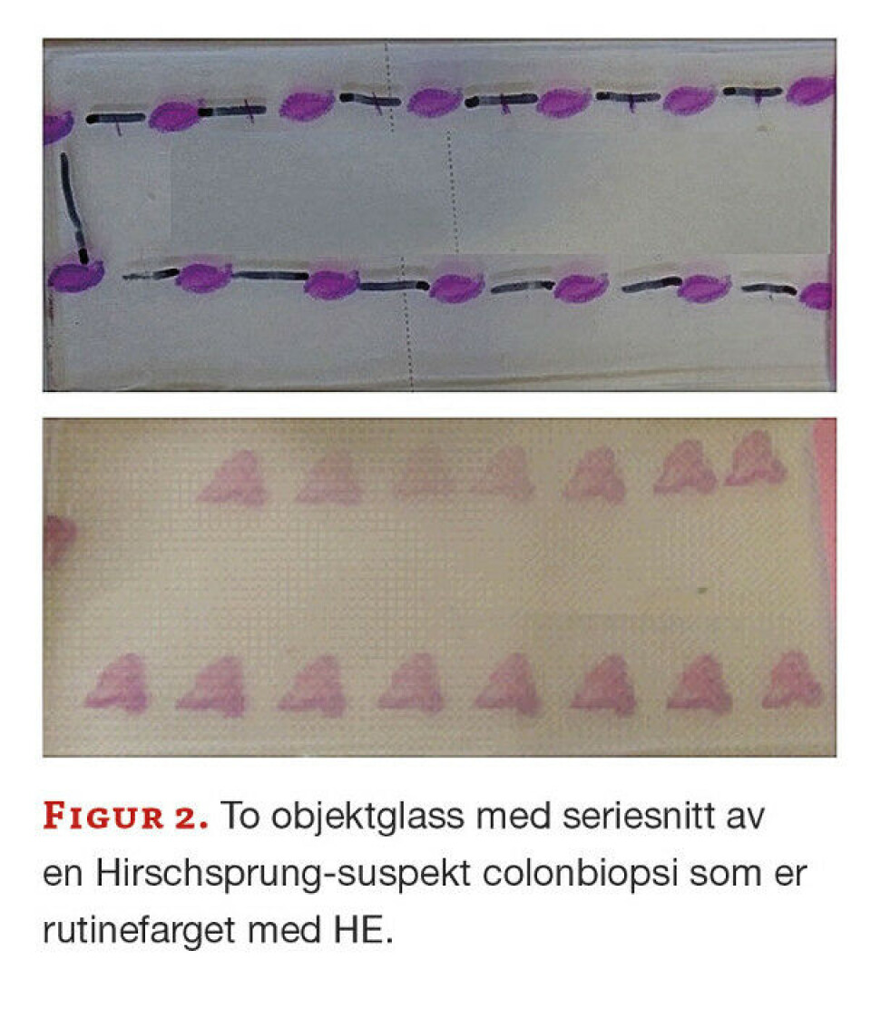 Hirschsprung sykdom - En standardisert prosedyre for suspekte colonbiopsier