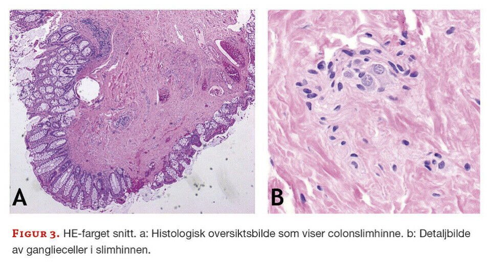 Hirschsprung sykdom - En standardisert prosedyre for suspekte colonbiopsier