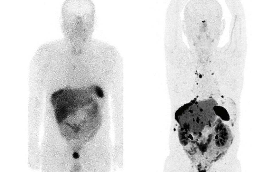 Ny og bedre metode for diagnostikk og oppfølging av nevroendokrine svulster