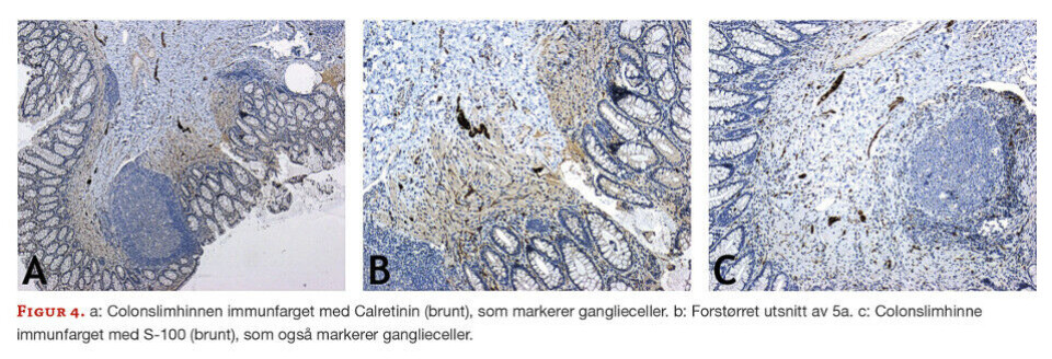 Hirschsprung sykdom - En standardisert prosedyre for suspekte colonbiopsier