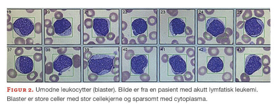 Slik påvises akutt leukemi med hematologiske metoder