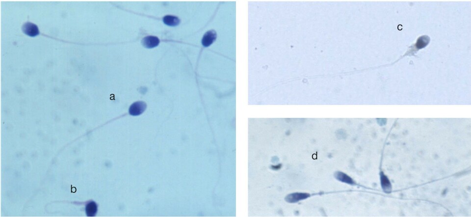 Figur 3: Spermiemorfologi. Spermier farget med Papanicolaou-fargeløsning for spermier. a klassifiseres som morfologisk normal spermie. b (midtstykke- og halefeil), c (uregelmessig hodefasong og cytoplasmadråpe) og d (for lange og smale hoder) klassifiseres som morfologisk unormale spermier. Foto: Roelof Menkveld