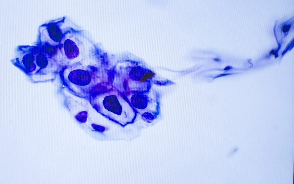 Hpv-testing og cervixcytologi skal samles på tre laboratorier i Helse Sør-Øst. Bildet viser lavgradige celleforandringer (LSIL) fra livmorhals. Illustrasjonsfoto: Tomas Moss, tomas@icu.no